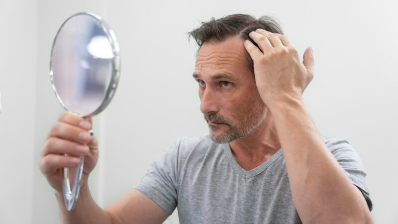 Tratamentos ampliam alternativas para calvície masculina