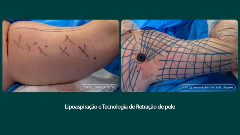 Tratamento remove flacidez do braço com tecnologia associada