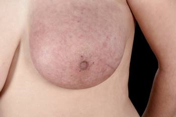 Pacientes com câncer de mama que dependem do SUS não têm atualização terapêutica há quase 20 anos