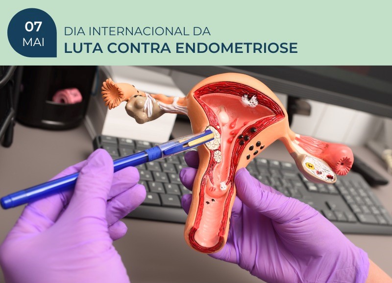A importância da atenção individualizada à mulher no manejo da endometriose