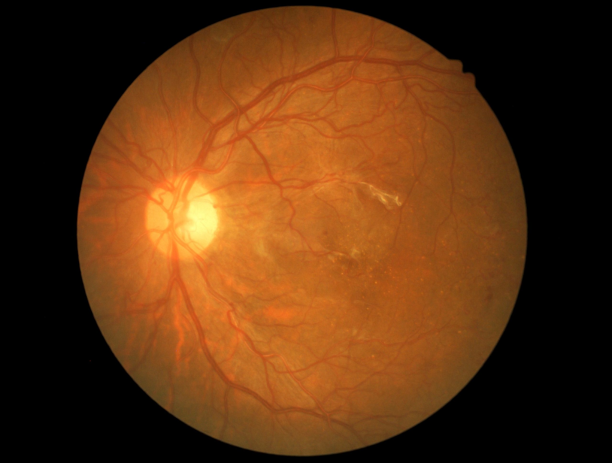 Descontrole das taxas de açúcar pode levar a retinopatia diabética