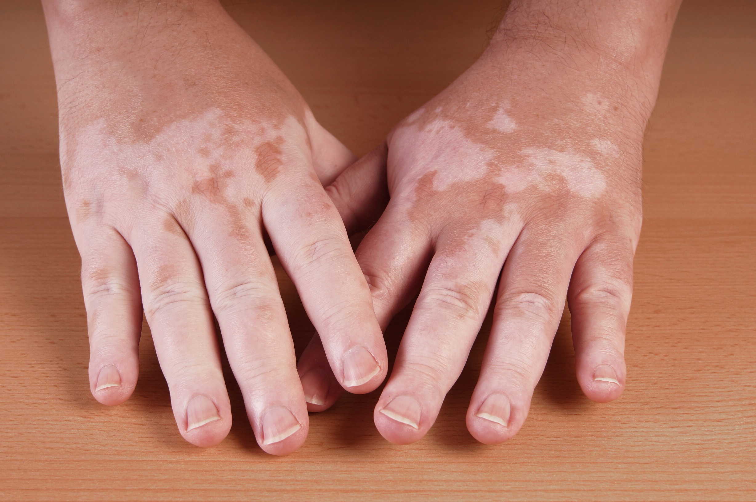 Vitiligo: quais as principais características desta doença dermatológica?