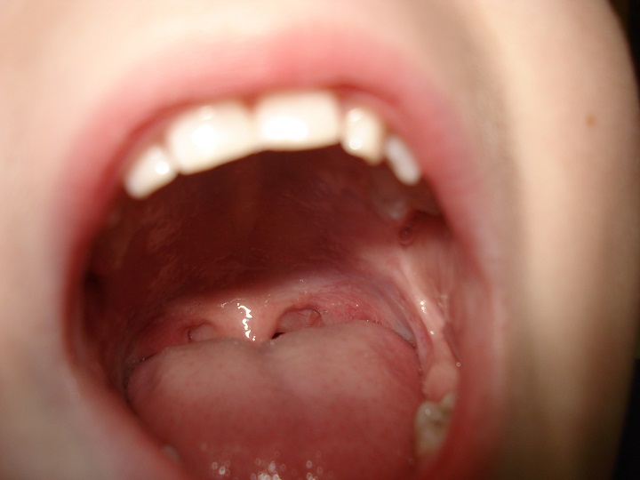 Síndrome da boca ardente: doença intriga médicos e não tem cura