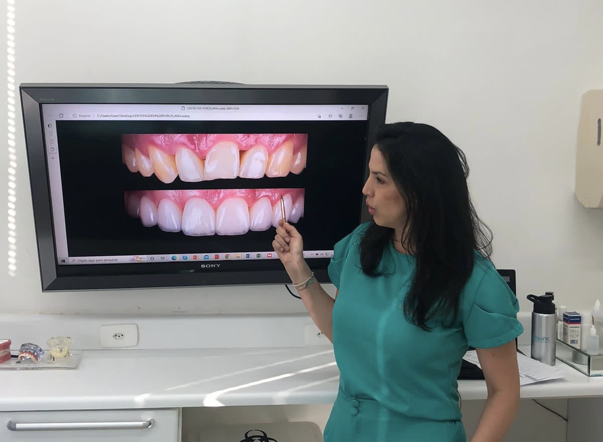 Cirurgiã dentista explica as diferenças entre lentes de resina e de porcelana