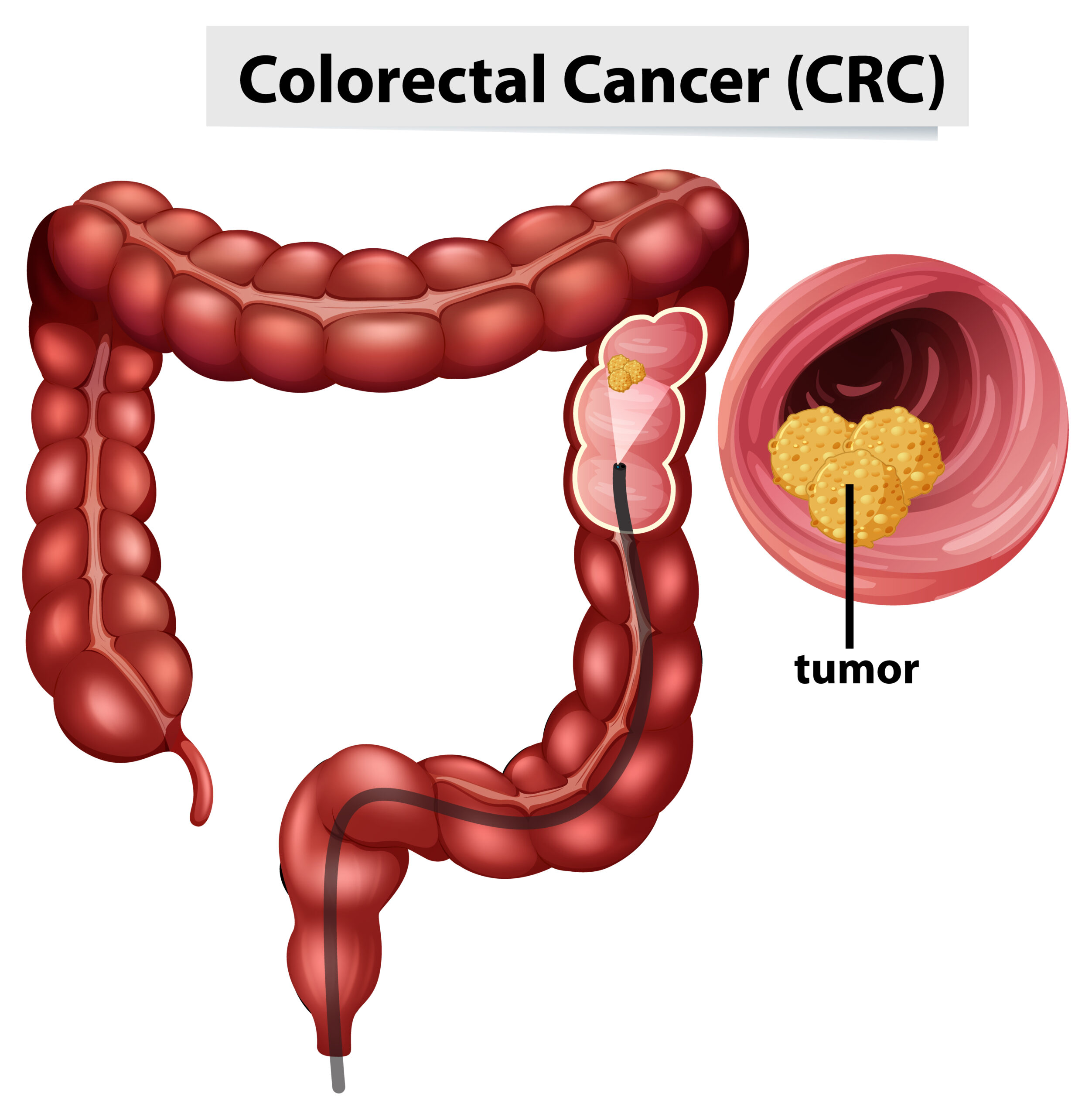 Cresce o diagnóstico de câncer no intestino no Brasil