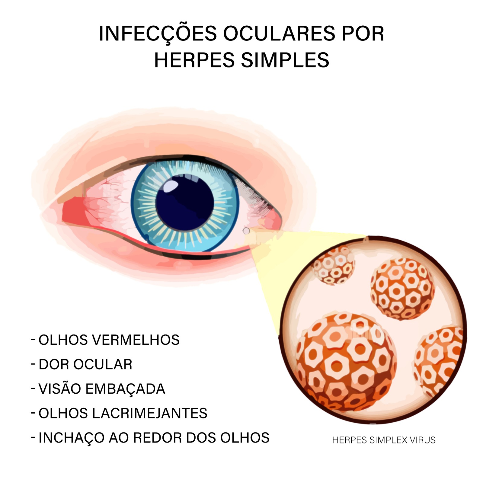 Infecções oculares por Herpes Simples têm tratamento