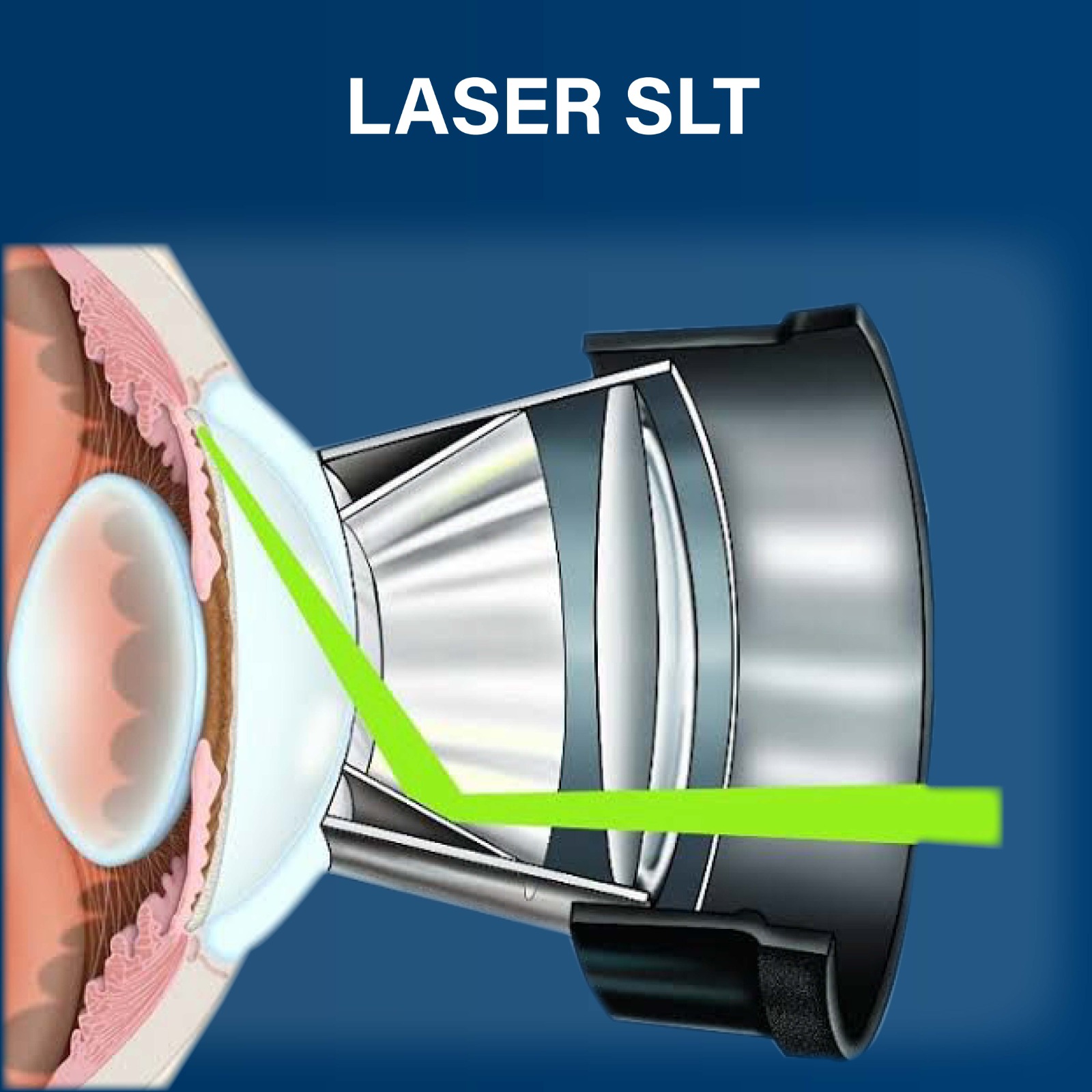Laser SLT é utilizado no tratamento do glaucoma