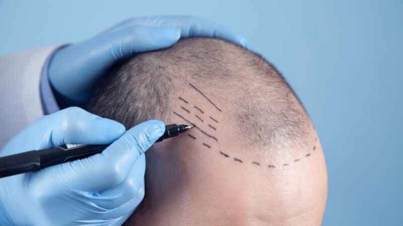 Tecnologia visa mais naturalidade em transplante capilares