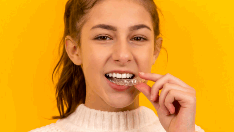 Alinhador invisível: como funciona o tratamento dentário