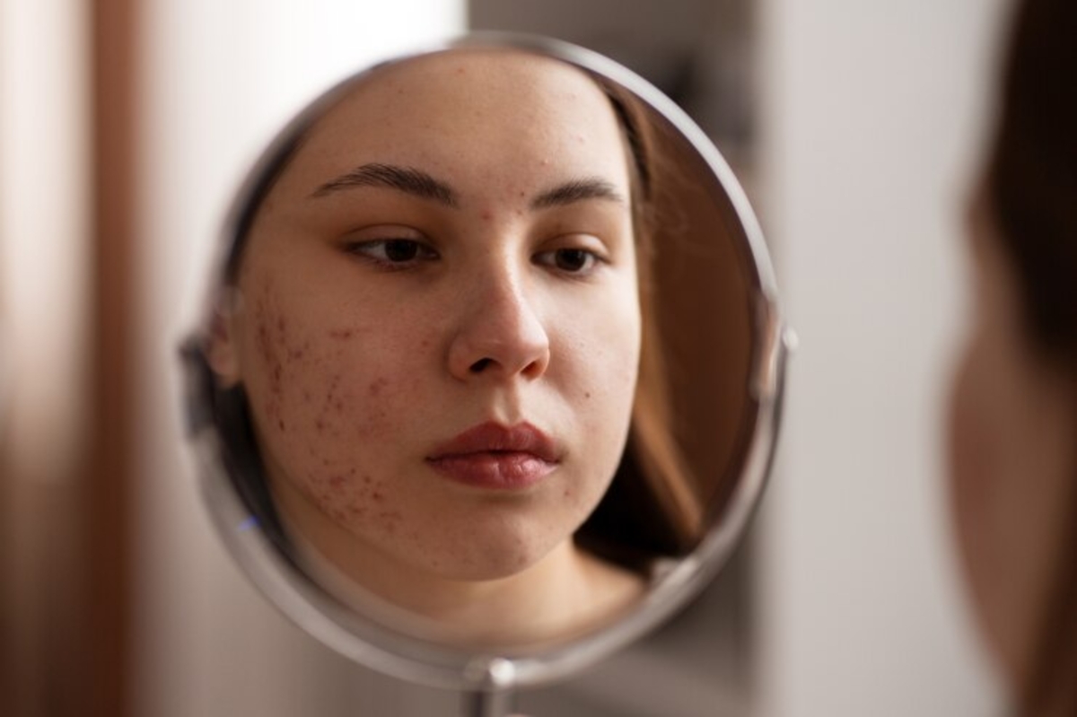 Acne se torna cada vez mais comum entre mulheres adultas