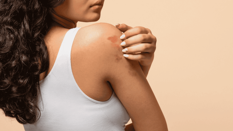 Mês da Dermatite Atópica: os impactos da doença na pele