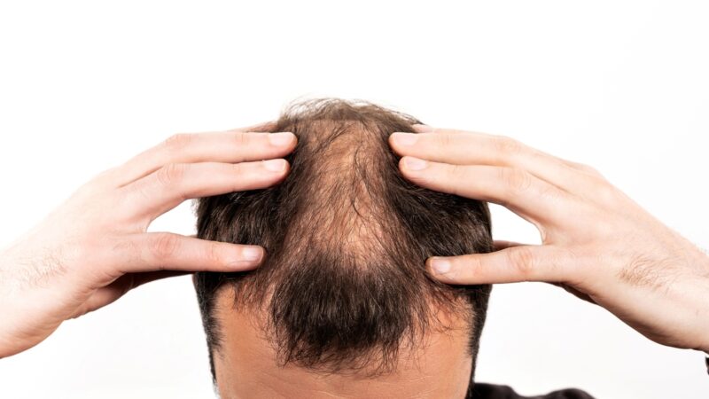Alopecia: técnicas de tricologia podem oferecer soluções