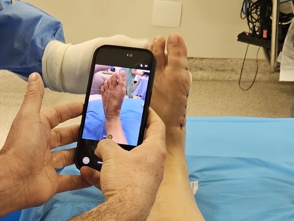 Tratamento das joanetes avança com cirurgia pouco invasiva