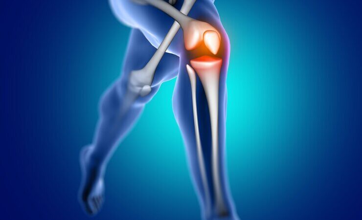 Artroplastia de joelho e quadril: para que serve a cirurgia