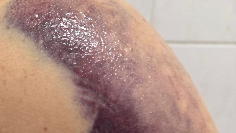 Paciente com ombro quebrado espera cirurgia desde quarta-feira e família denuncia abandono na Santa Casa de Maringá