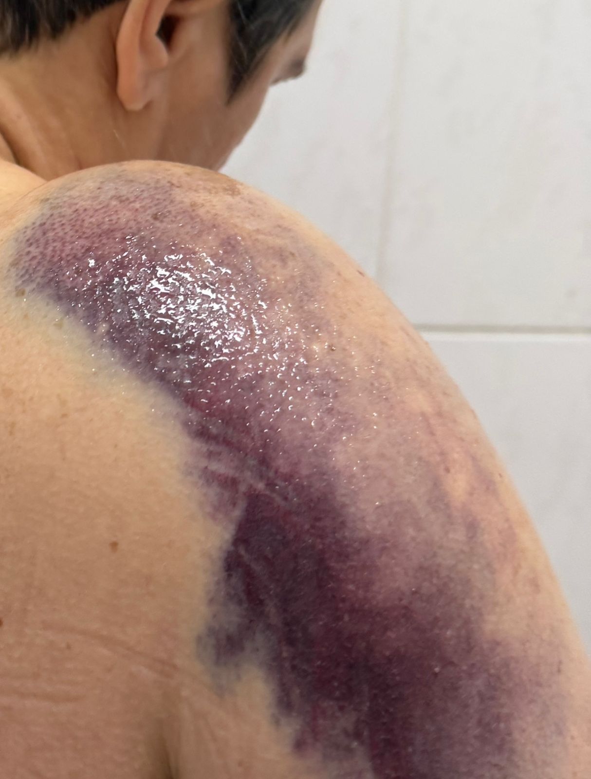 Paciente com ombro quebrado espera cirurgia desde quarta-feira e família denuncia abandono na Santa Casa de Maringá