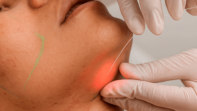 Laser subdérmico surge como alternativa à lipoaspiração
