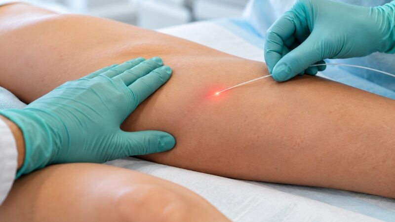 Laser permite tratar a safena sem retirar a veia da perna