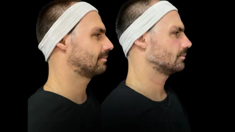 O Papo, a Papada ou a Papuda o que complica mais a vida  de Eduardo Bolsonaro?