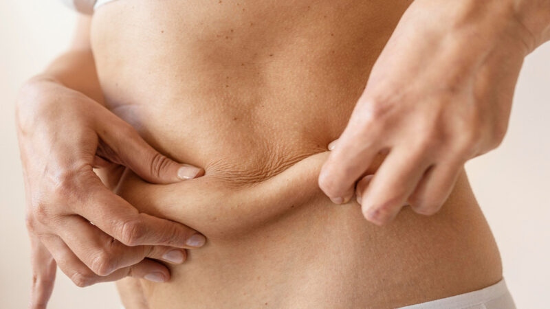Tecnologia melhora retração da pele após lipoaspiração