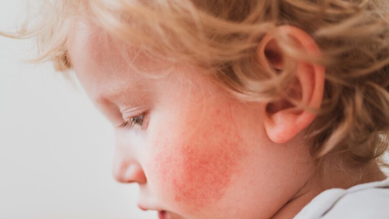 Alergia alimentar mais comum em bebês de até um ano: conheça a APLV
