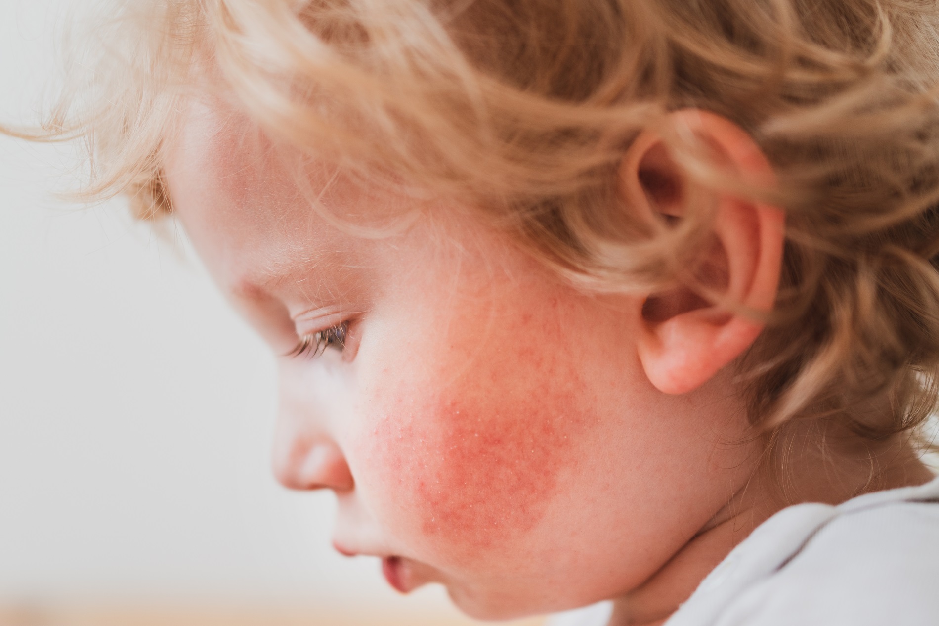 Alergia alimentar mais comum em bebês de até um ano: conheça a APLV