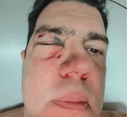 Discussão sobre IPTU termina em violência: cliente relata que teve o nariz quebrado após conflito com Imobiliária Facilita