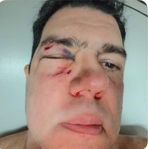 Discussão sobre IPTU termina em violência: cliente relata que teve o nariz quebrado após conflito com Imobiliária Facilita